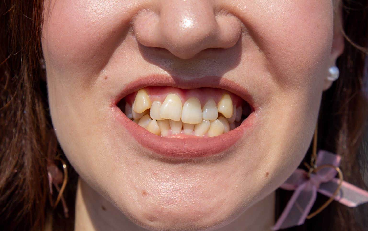 The Effect of Thumb Sucking on Teeth and How to Get Your Child to Stop ...