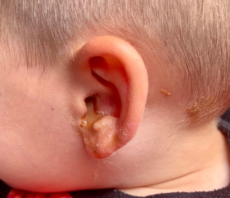 Does Your Child Have Ear Drainage with Tubes? What It Is and When to